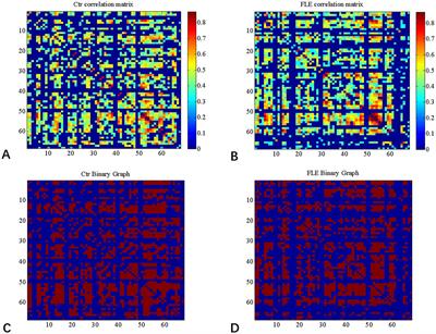 Topological abnormality of structural covariance network in MRI-negative frontal lobe epilepsy